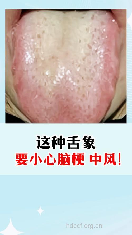 老人常咬舌头小心脑梗塞