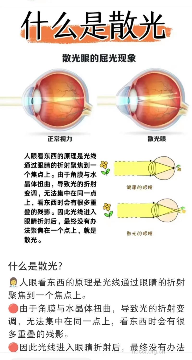 全面解析散光眼的几大分类