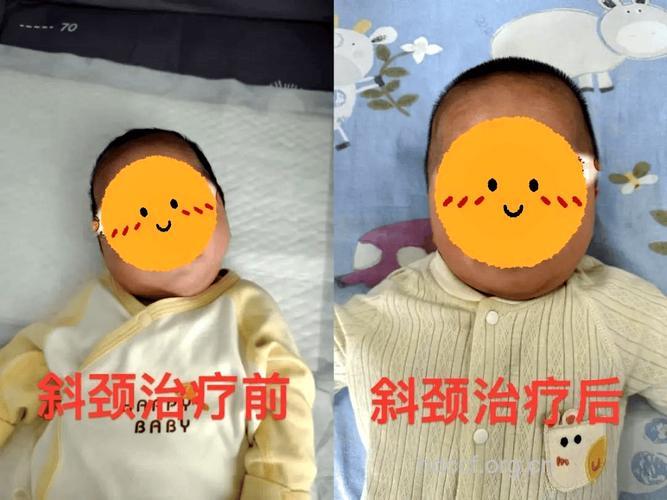 家长注意 小孩歪脖子可能是斜视