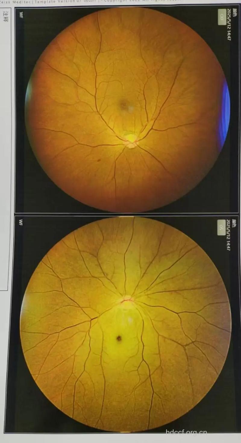 眼科急症:视网膜中央动脉阻塞