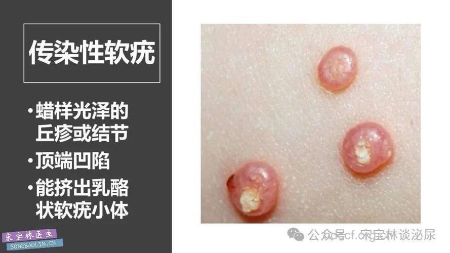 正确鉴别诊断传染性软疣