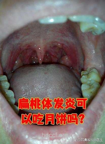 吃月饼也会引发扁桃体炎
