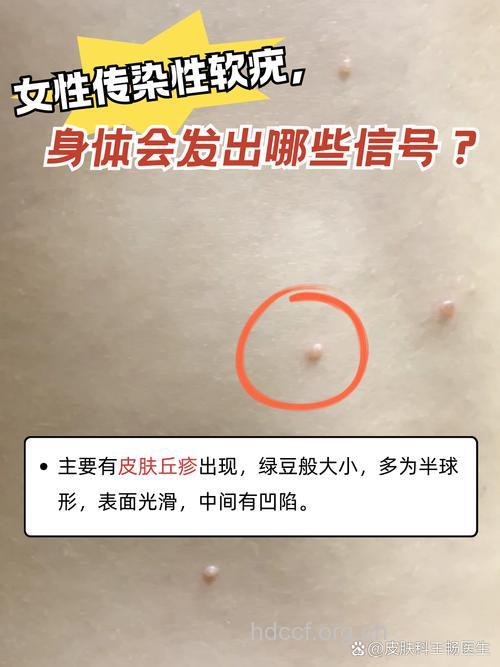 成人与儿童传染性软疣的症状