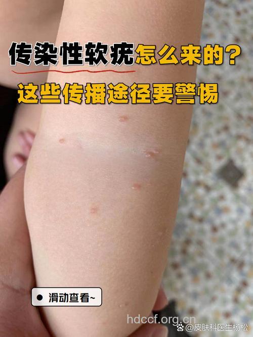 传染性软疣的传播方式