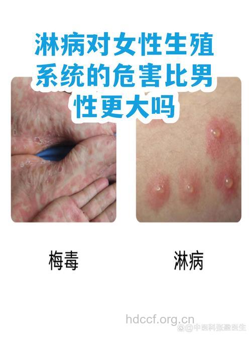 性病对人们有什么危害