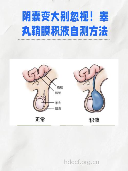 男性睾丸鞘膜积液的检查方法