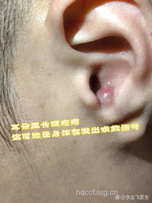 耳朵里长痘痘是怎么回事 当心外耳道疖