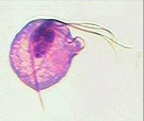 一场由阴道毛滴虫病引起的婚变