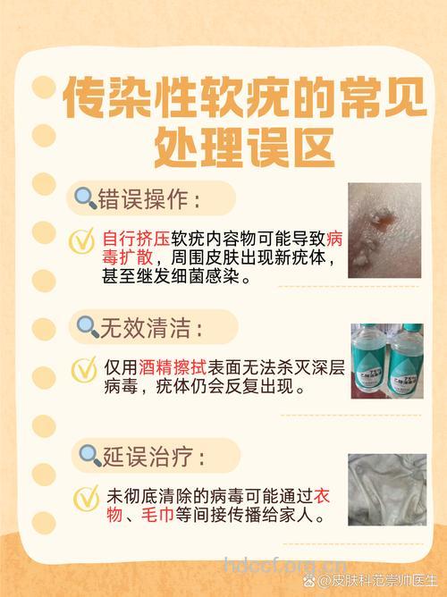 小心阴部传染性软疣的治疗误区