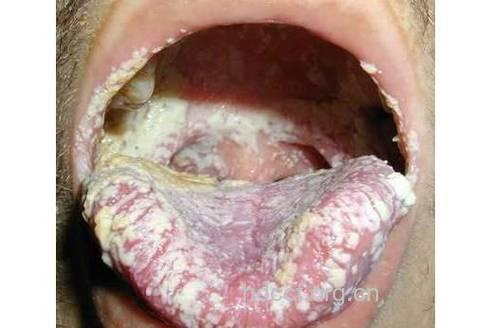 生殖器念珠菌病有哪些危害