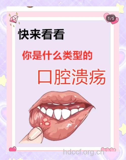 这5种人群是口腔溃疡的高发人群