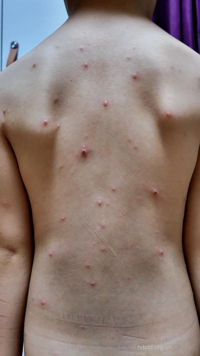 孩子出水痘的症状及过程