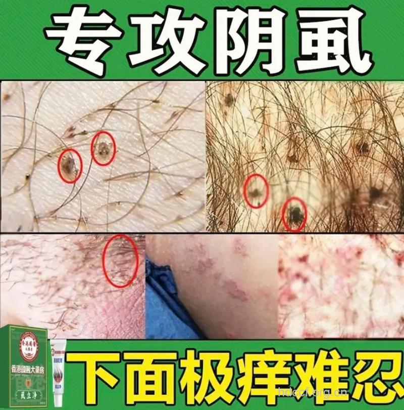 无名之痒原来是阴虱惹的祸