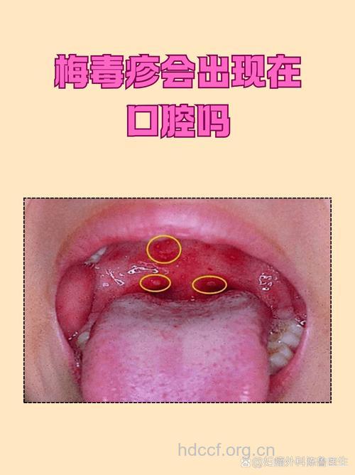 警惕 隐藏在口腔中的性病