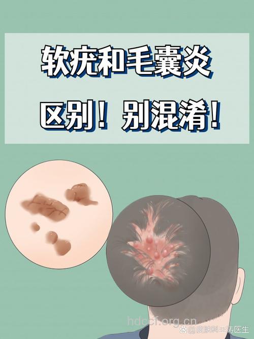 传染性软疣容易跟什么病混淆