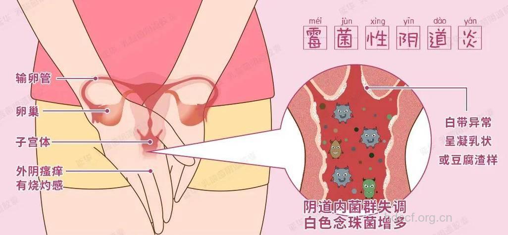 酷爱甜 女性易惹念珠菌阴道炎