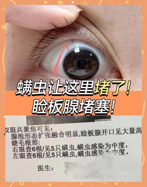 汗!眼部耻也有阴虱寄生