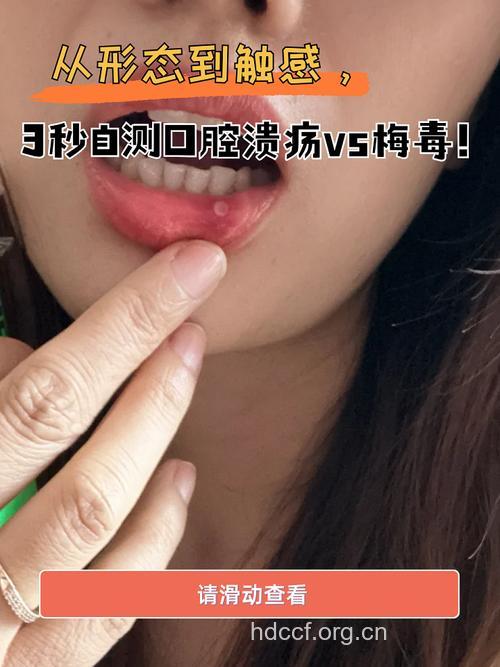 口腔溃疡如何诊断检测