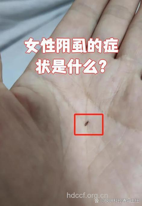 惊！阴毛长虱子可能是性病早期症状