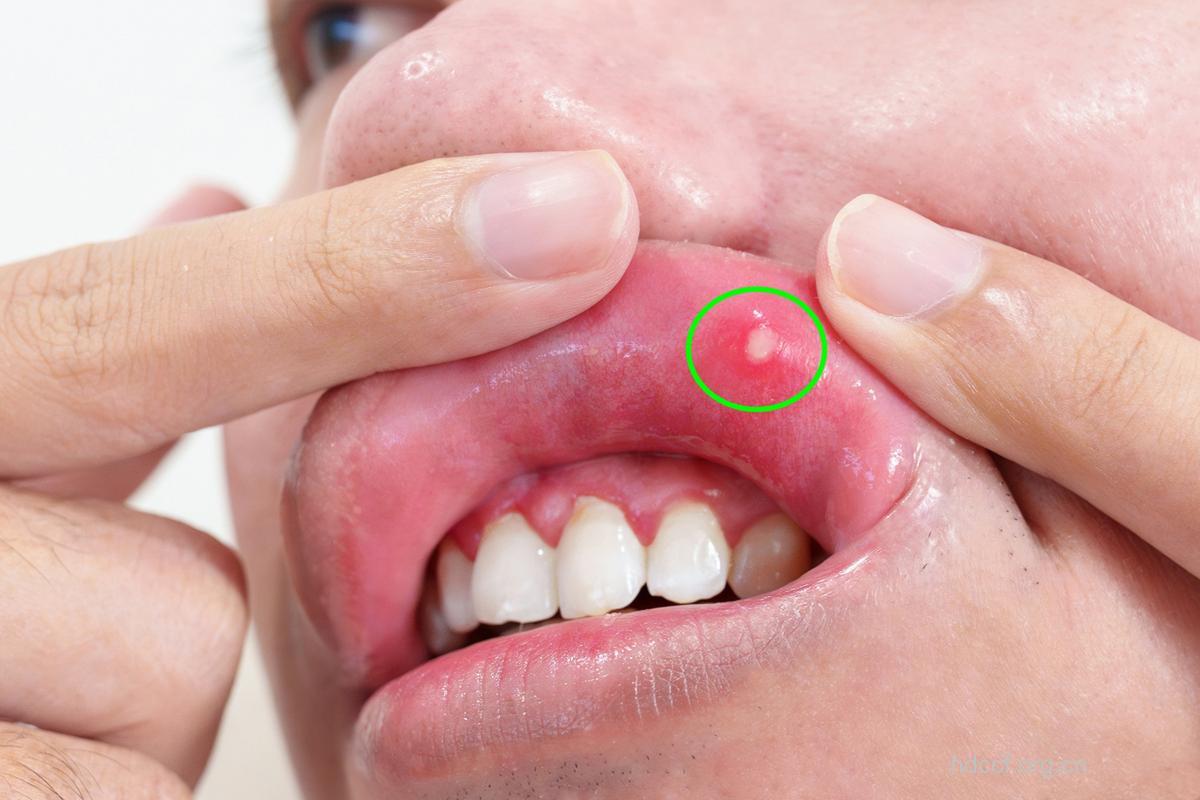 三个常见的口腔溃疡症状
