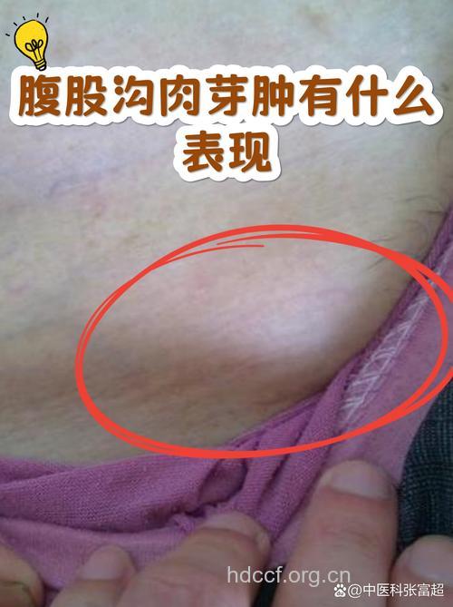 认识腹股沟肉芽肿的临床表现