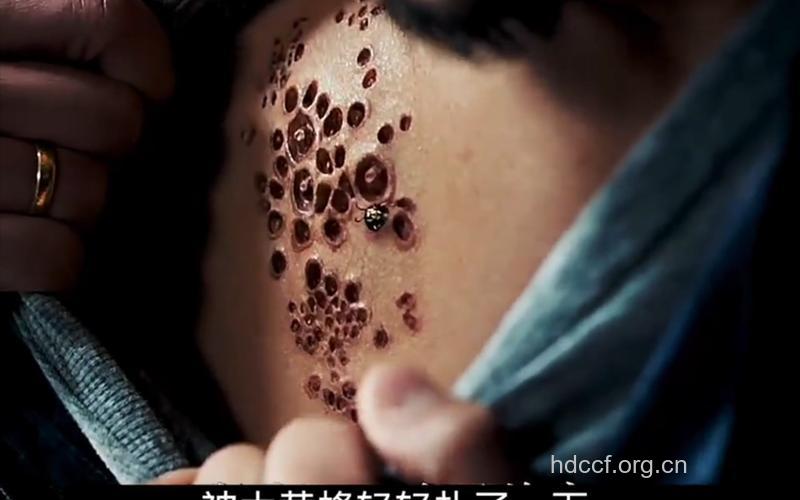 密集恐惧症的症状以及治疗方法