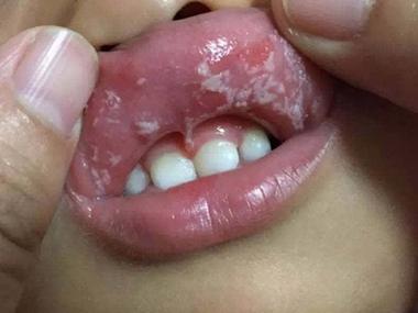 多动症小孩易得自伤性口腔溃疡