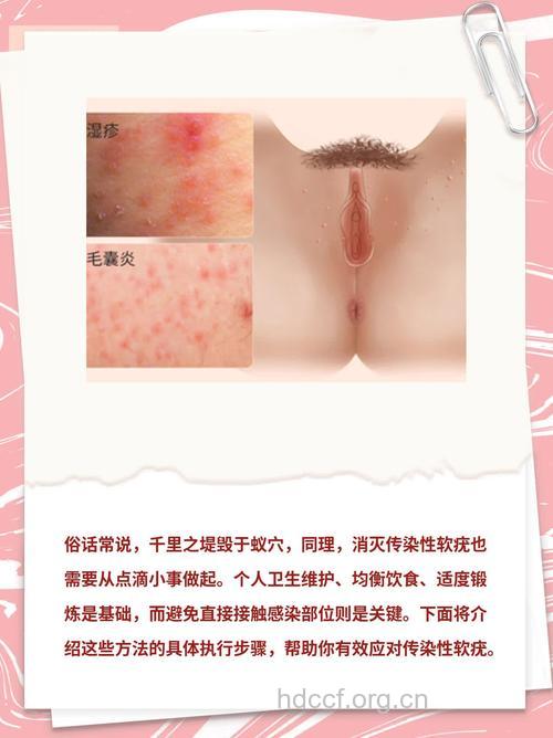 治疗传染性软疣的小偏方