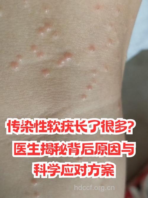 看看西医是怎样治疗传染性软疣