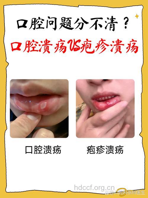 口腔溃疡与口腔糜烂症状辨别