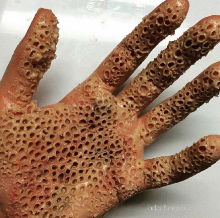 疾病百科 密集恐惧症是什么