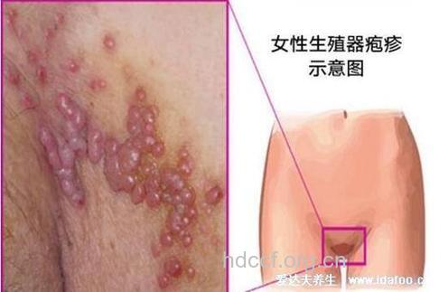 感染艾滋病的胃肠道症状