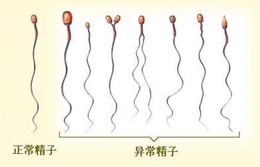 精液异常五病因 七危害导致男性不育