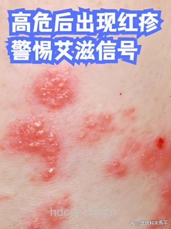 高危后出现了艾滋病症状怎么办