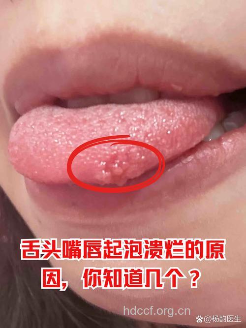 引起口舌生疮的4个原因