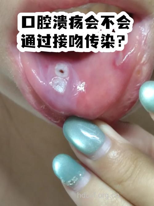 接吻会不会传染口腔溃疡？