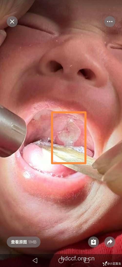奶粉加白糖治宝宝口腔溃疡