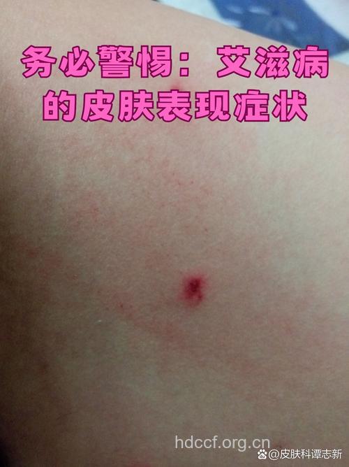 警惕 三种导致艾滋病的美容行为