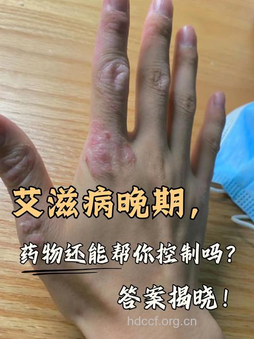 还谈艾色变吗 艾滋病不是那么容易得的
