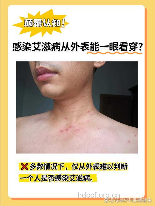 天生免疫艾滋病 对艾滋病免疫的人真存在