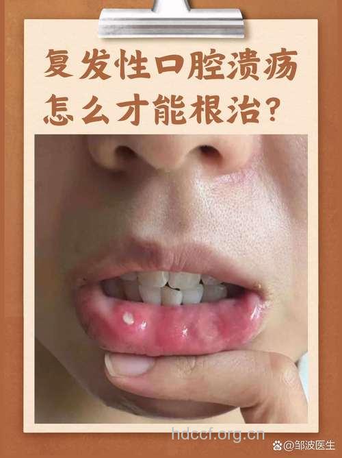 如何辨别轻重型复发性口腔溃疡