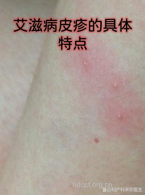 艾滋病感染的早期症状