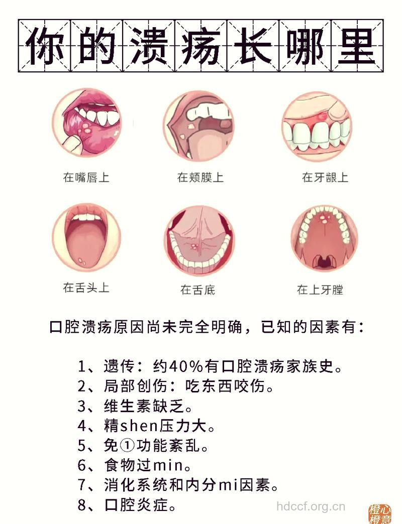 口腔溃疡的治疗原则