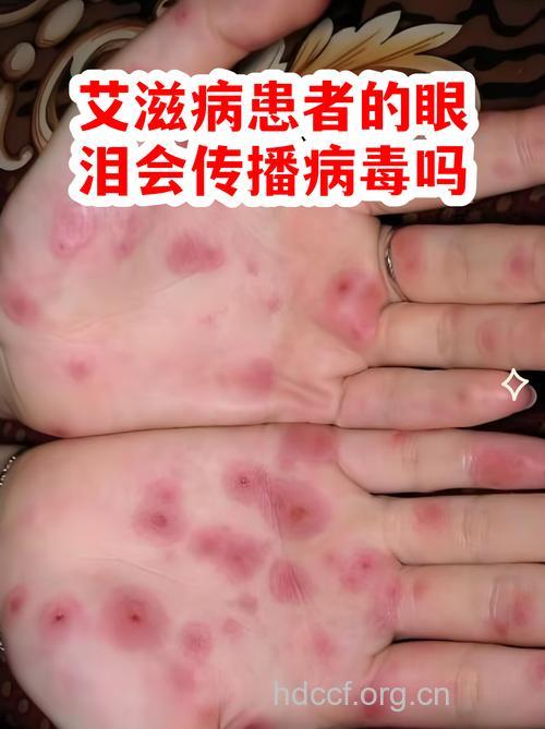 艾滋病人眼泪中含有艾滋病毒