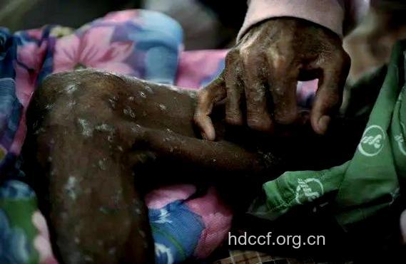 存活时间最长的先天性艾滋病患者