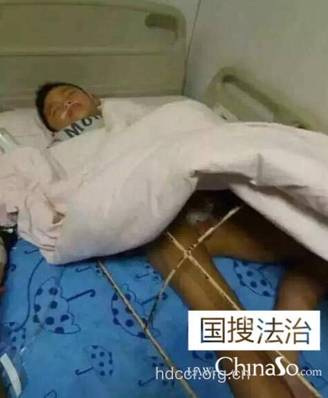 哪些生殖器外伤会影响生育能力