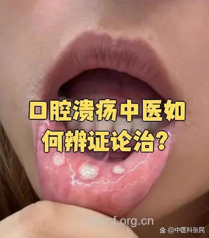 中医辨证治疗口腔溃疡