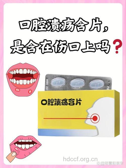 频含喉片小心致口腔溃疡