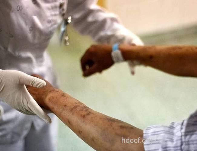 艾滋病毒入侵人体全过程被偷拍