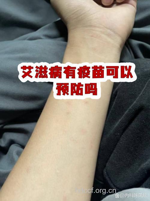 新艾滋疫苗使感染风险降低33%